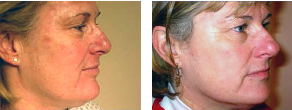 Before And After Photos Mountain View - Chemical Peels Image 10