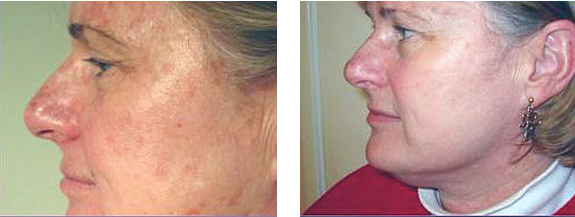Before And After Photos Mountain View - Chemical Peels Image 11