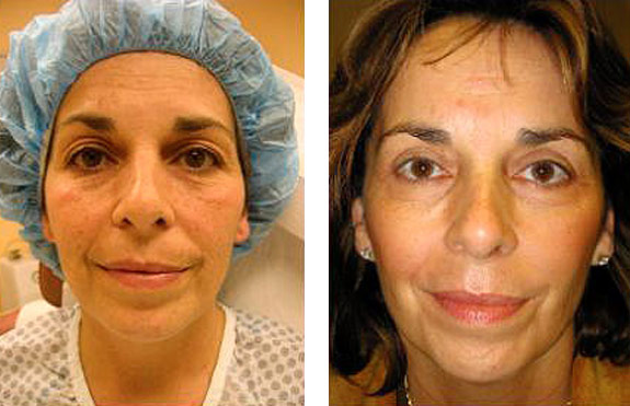 Before And After Photos Mountain View - Chemical Peels Image 13