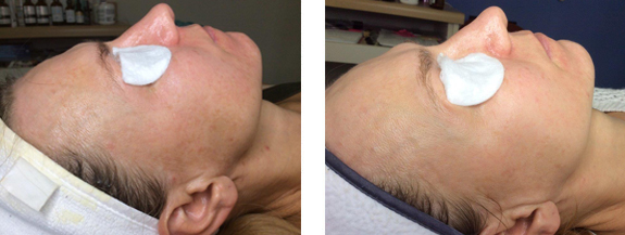 Before And After Photos Mountain View - Chemical Peels Image 15