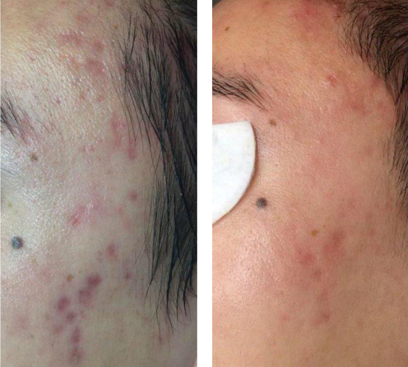 Before And After Photos Mountain View - Chemical Peels Image 16