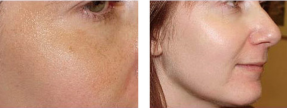 Before And After Photos Mountain View - Chemical Peels Image 03