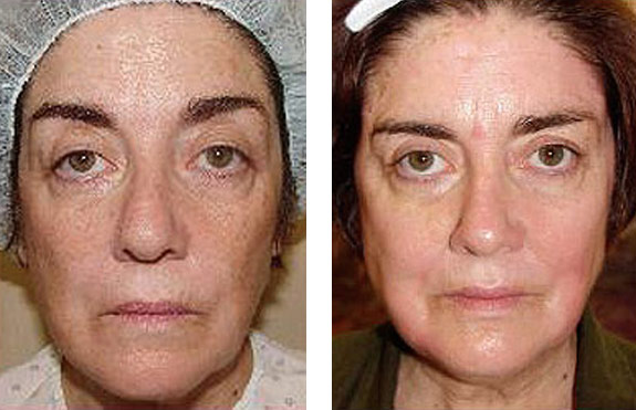 Before And After Photos Mountain View - Chemical Peels Image 04