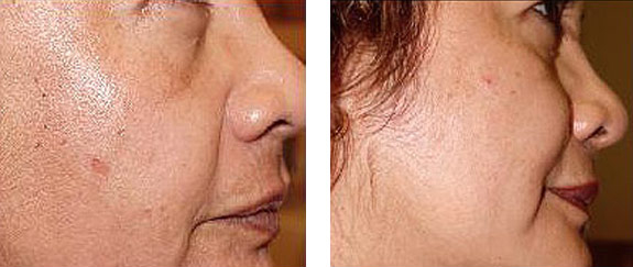 Before And After Photos Mountain View - Chemical Peels Image 08