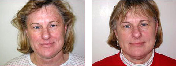 Before And After Photos Mountain View - Chemical Peels Image 09