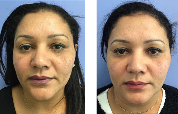 Clear + Brilliant - Post 1 Treatment