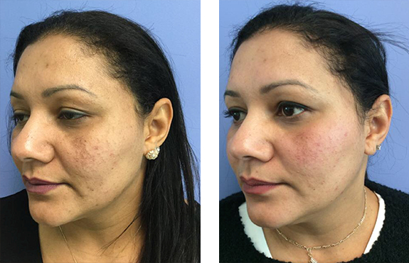 Clear + Brilliant - Post 1 Treatment