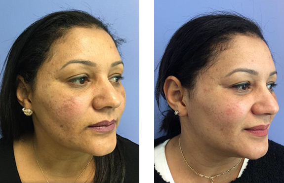 Clear + Brilliant - Post 1 Treatment