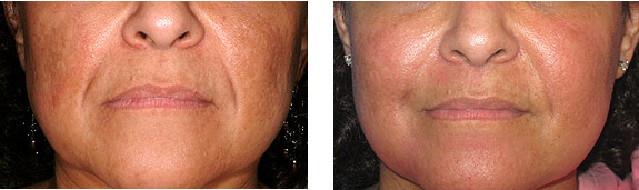 Before And After Photos Mountain View - Laser Resurfacing Image 01