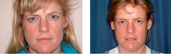 Before And After Photos Mountain View - Laser Resurfacing Image 10