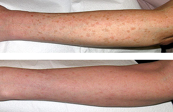 Before And After Photos Mountain View - Laser Resurfacing Image 11