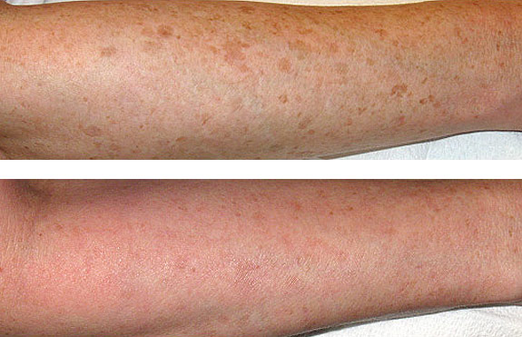Before And After Photos Mountain View - Laser Resurfacing Image 12