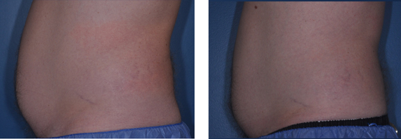 Before And After Photos Mountain View - CoolSculpting Image 16