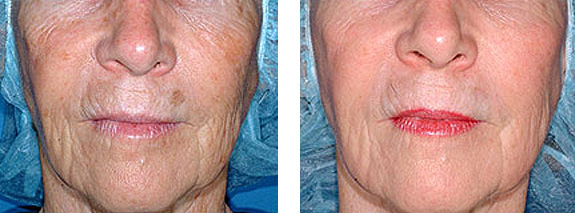 Before And After Photos Mountain View - Laser Resurfacing Image 02