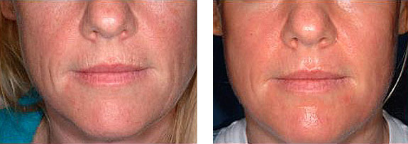 Before And After Photos Mountain View - Laser Resurfacing Image 08