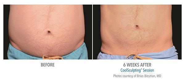 Before And After Photos Mountain View - CoolSculpting abdomen case 1
