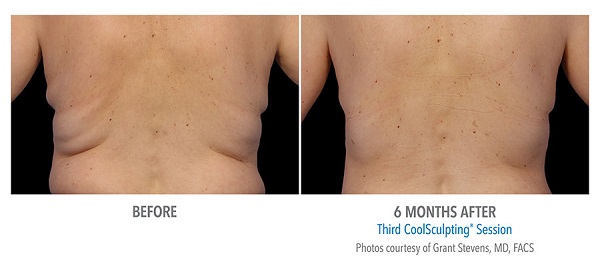 Before And After Photos Mountain View - CoolSculpting flank case 1