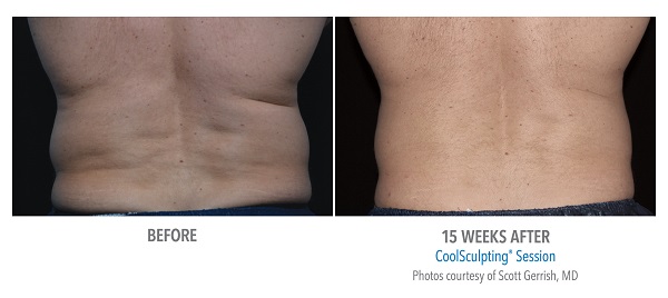 Before And After Photos Mountain View - CoolSculpting flank case 2