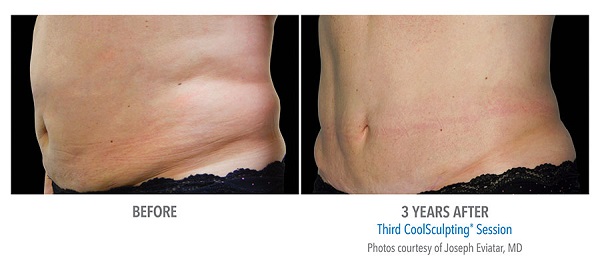 Before And After Photos Mountain View - CoolSculpting flank case 3