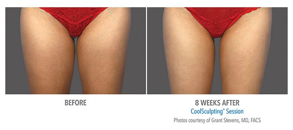 Before And After Photos Mountain View - CoolSculpting inner thigh case 1.jpg
