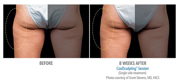 Before And After Photos Mountain View - CoolSculpting outer thigh case 1.jpg