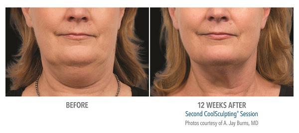 Before And After Photos Mountain View - CoolSculpting submentum case 1.jpg