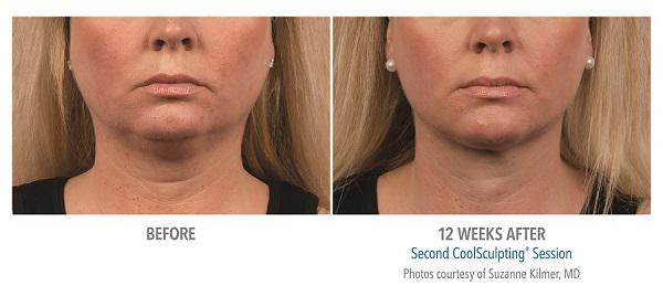 Before And After Photos Mountain View - CoolSculpting submentum case 2 
