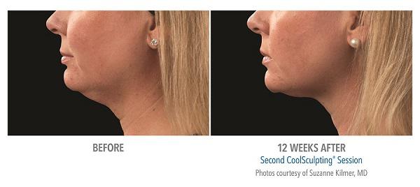 Before And After Photos Mountain View - CoolSculpting submentum case 3 