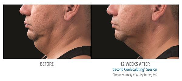 Before And After Photos Mountain View - CoolSculpting submentum case 4 