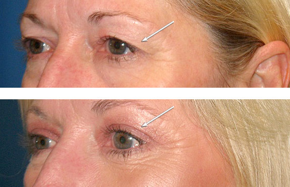Before And After Photos Mountain View - Eyelid Rejuvenation Image 11