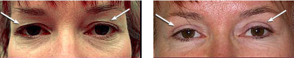 Before And After Photos Mountain View - Eyelid Rejuvenation Image 13