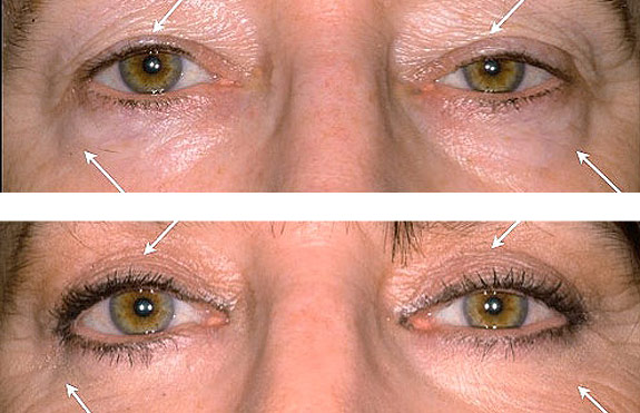 Before And After Photos Mountain View - Eyelid Rejuvenation Image 14