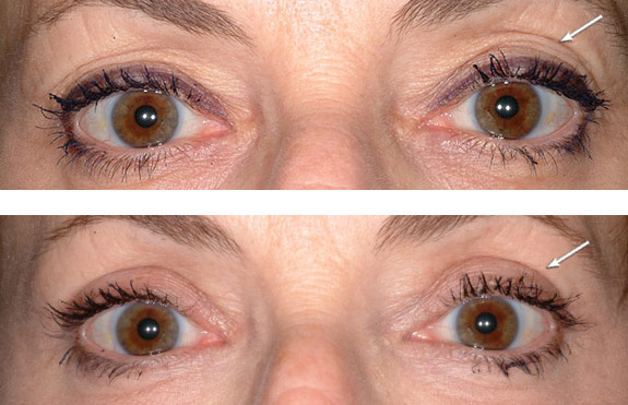 Before And After Photos Mountain View - Eyelid Rejuvenation Image 15