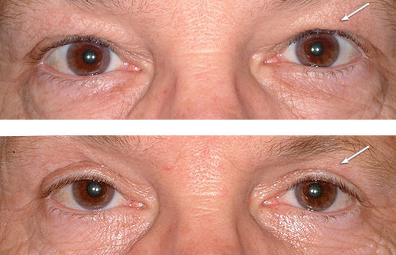 Before And After Photos Mountain View - Eyelid Rejuvenation Image 17