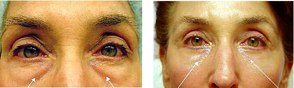 Before And After Photos Mountain View - Eyelid Rejuvenation Image 18