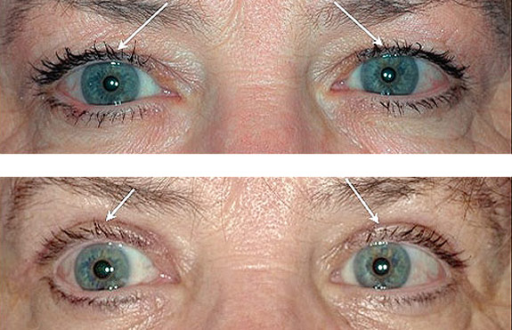 Before And After Photos Mountain View - Eyelid Rejuvenation Image 19