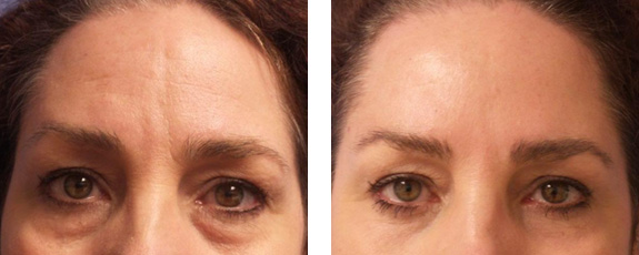 Before And After Photos Mountain View - Eyelid Rejuvenation Image 23