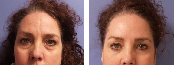Before And After Photos Mountain View - Eyelid Rejuvenation Image 24