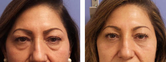 Before And After Photos Mountain View - Eyelid Rejuvenation Image 25