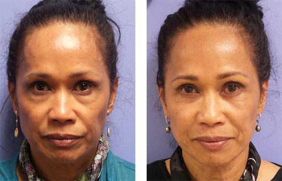 Before And After Photos Mountain View - Eyelid Rejuvenation Image 26
