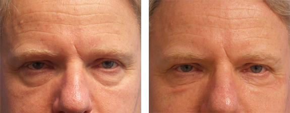 Before And After Photos Mountain View - Eyelid Rejuvenation Image 28