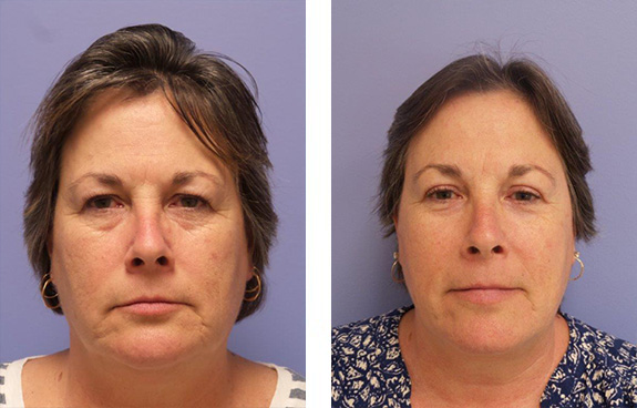Before And After Photos Mountain View - Eyelid Rejuvenation Image 29