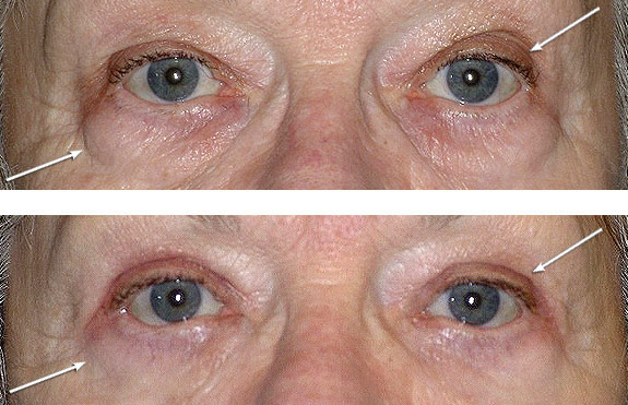Before And After Photos Mountain View - Eyelid Rejuvenation Image 03