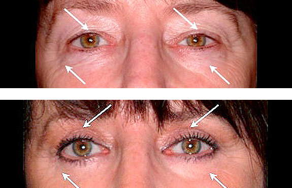Before And After Photos Mountain View - Eyelid Rejuvenation Image 06