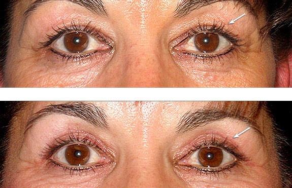Before And After Photos Mountain View - Eyelid Rejuvenation Image 08