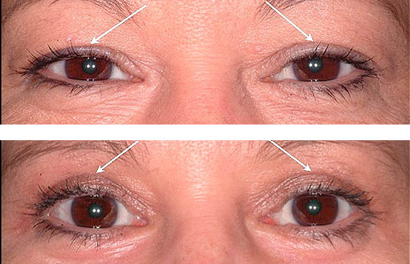 Before And After Photos Mountain View - Eyelid Rejuvenation Image 09