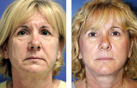 Before And After Photos Mountain View - Face and Neck Lifting Image 01