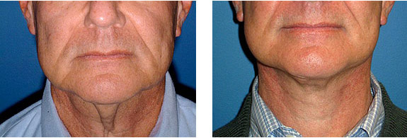 Before And After Photos Mountain View - Face and Neck Lifting Image 10