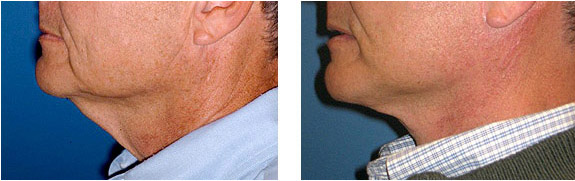 Before And After Photos Mountain View - Face and Neck Lifting Image 11