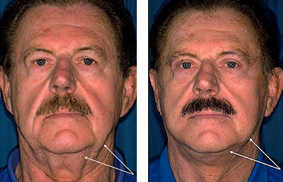 Before And After Photos Mountain View - Face and Neck Lifting Image 12